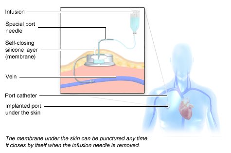 Illustration: Chemotherapy: Infusion with a port