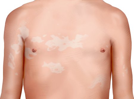 Illustration: Tinea versicolor on the upper body – as described in the information