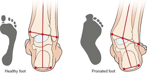 Illustration: Healthy foot and pronated foot – as described in the article