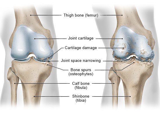Illustration: Front view of the right knee without the kneecap; on the left with osteoarthritis on one side of the knee joint (medial); on the right with advanced osteoarthritis on both sides of the knee joint (medial and lateral)