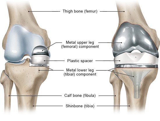 Illustration: Front view of the right knee; Left: Partial knee replacement; Right: Total knee replacement – as described in the article