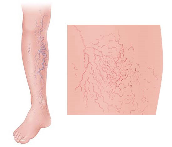 Illustration: Varicose veins and spider veins in the lower legs – as described in the article