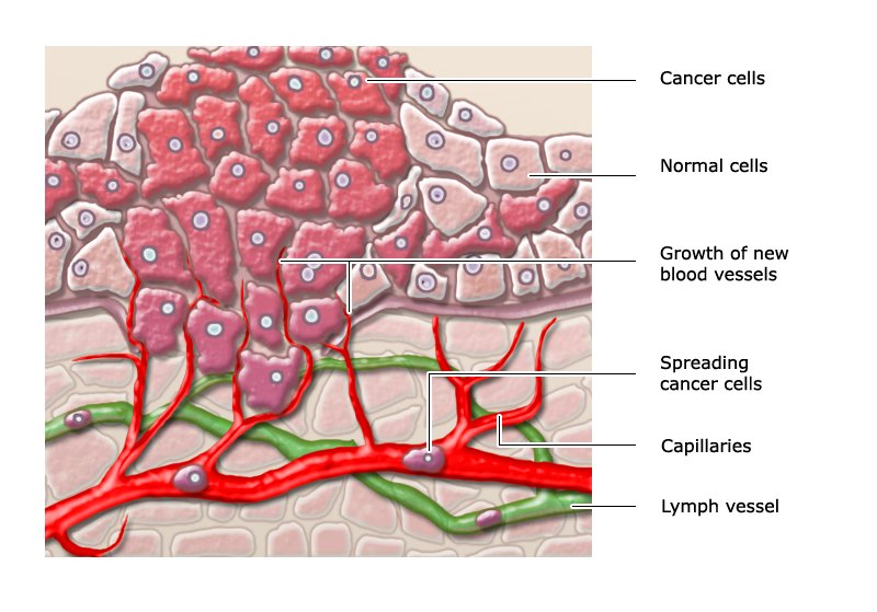 Illustration: Invasive cancer