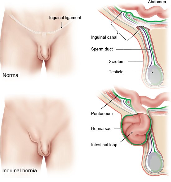 How are inguinal (groin) hernias treated in men?