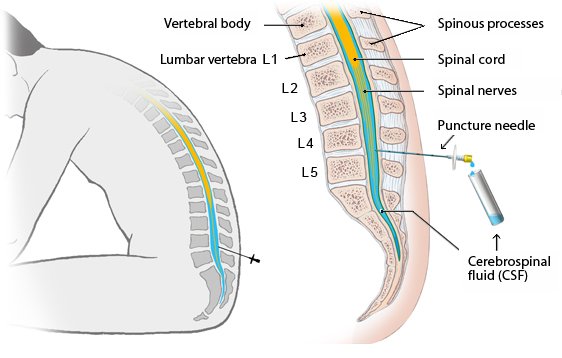 Illustration: Lumbar puncture in the lumbar (lower back) region of the spine – as described in the article