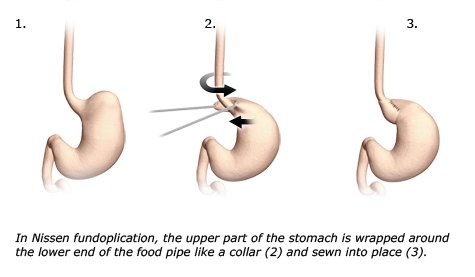 Illustration: Nissen fundoplication: The upper part of the stomach is wrapped around the lower end of the food pipe like a collar.
