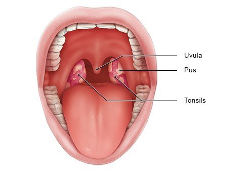 Illustration: Inside the mouth: Swollen, inflamed tonsils with pus-filled spots
