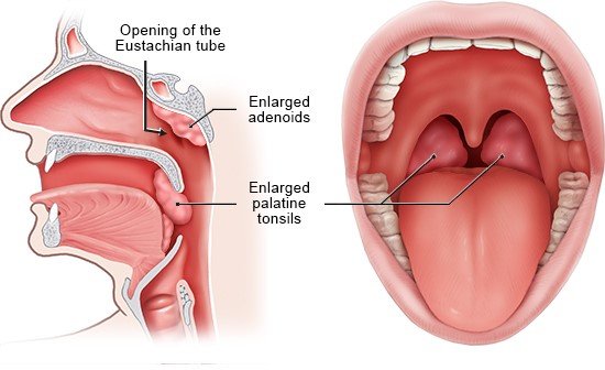 Illustration: Position of the tonsils and adenoids. Left: Cross section of the head from the side, Right: View into a the mouth 