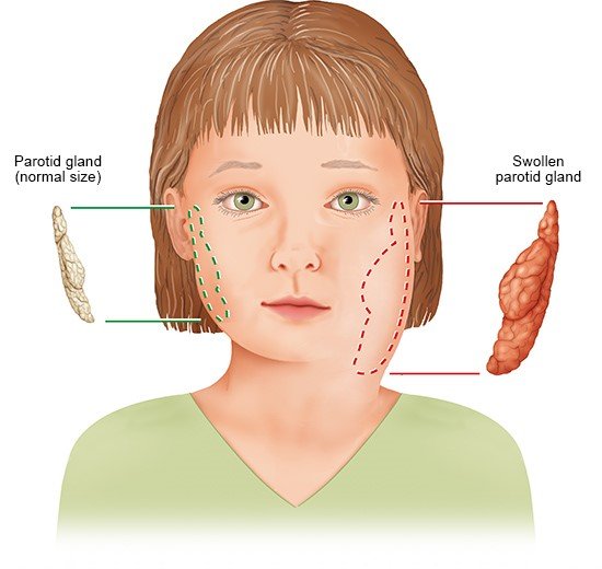 Illustration: Swollen cheek in a child with mumps