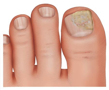 Illustration: Nail fungus on the big toenail