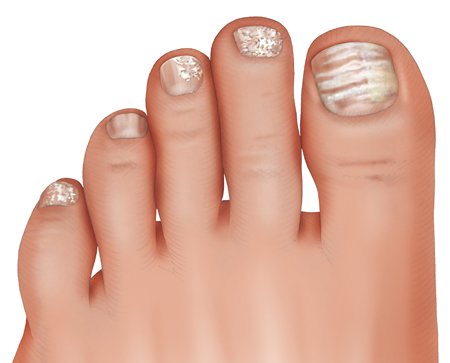 Illustration: White superficial onychomycosis on several toenails