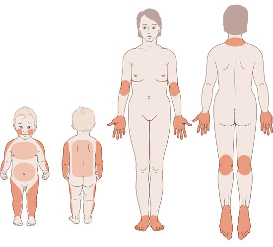 Illustration: Eczema in children and adults: Commonly affected areas of skin- as described in the article