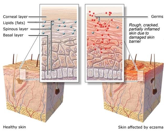 Illustration: Healthy skin and skin affected by eczema - as described in the article