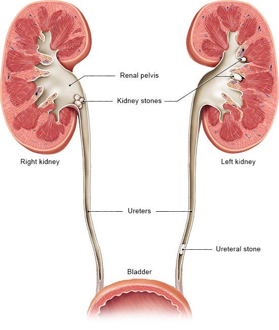 Illustration: The kidneys and ureters, with stones in various places