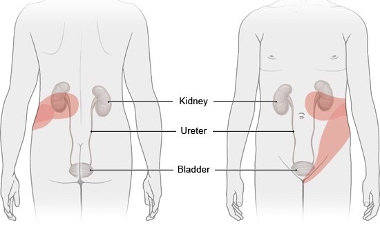 Illustration: Where kidney stone pain typically occurs – as described in the article