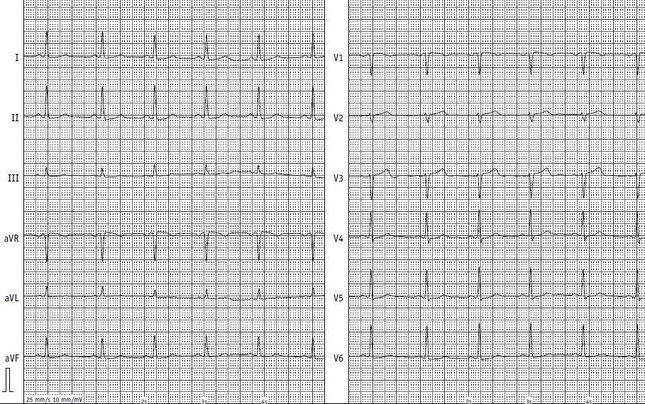 Illustration: Normal ECG – Left: the leads from the arms and legs, Right: the leads from the chest wall. Source: CCB Frankfurt a.M.