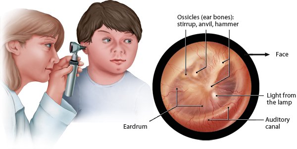 Illustration: Otoscopy and view of the eardrum – as described in the article