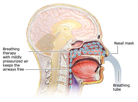 Illustration: CPAP therapy – as described in the article