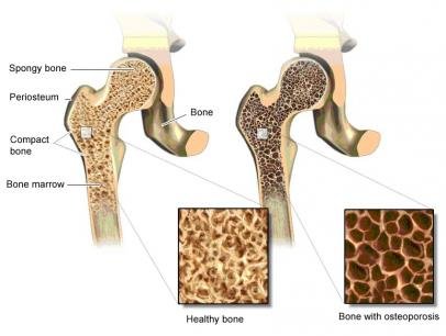 Illustration: Healthy bone tissue (left) and fragile bone tissue due to severe osteoporosis (right) – as described in the article