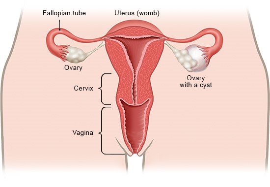 Illustration: Ovary with a cyst