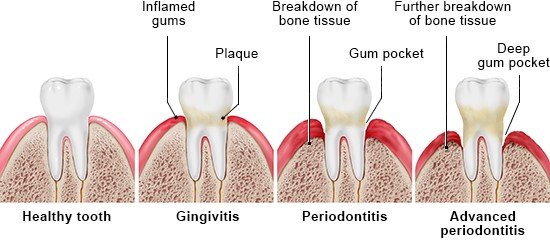 Illustration: Healthy tooth, gingivitis and periodontitis