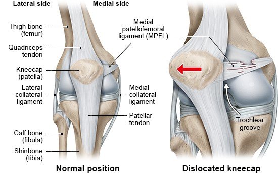 Illustration: Healthy knee joint (left) and dislocated knee (right)