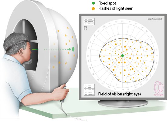 Illustration: Visual field test: Press a button everytime you see a flash