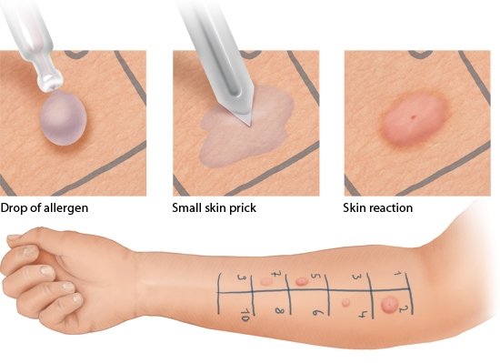 Illustration: Reaction to a prick test on light-colored skin