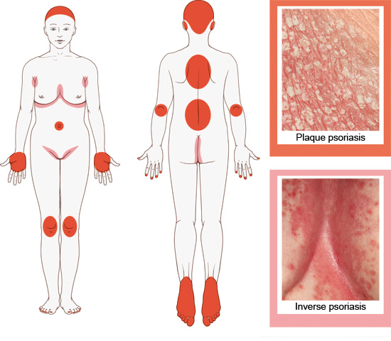 Illustration: Areas of skin affected by plaque psoriasis or inverse psoriasis – as described in the article