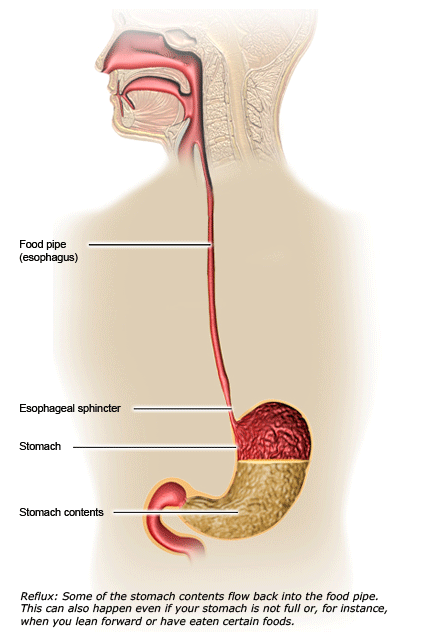 Animated reflux illustration: Stomach contents flow back up into the food pipe