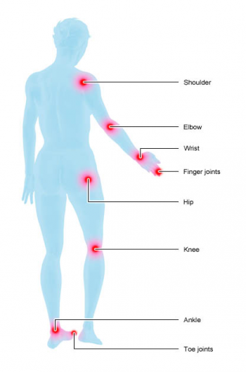 Illustration: Joints commonly affected by rheumatoid arthritis