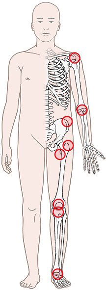 Illustration: Inflamed bursa: commonly affected parts of the body