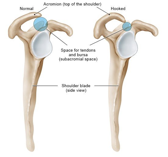 Illustration: Normal and hooked acromion (side view of the right shoulder)