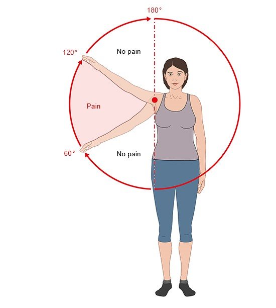 Illustration: Positions where subacromial pain occurs