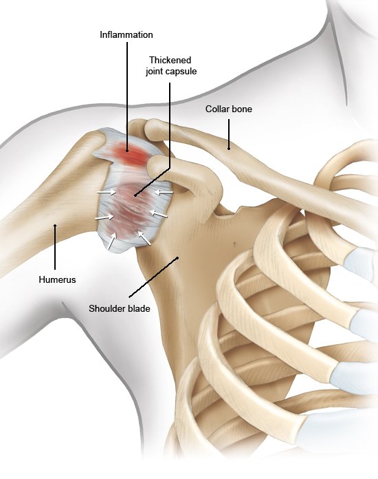 Illustration: Shoulder with an inflamed joint capsule – as described in the article