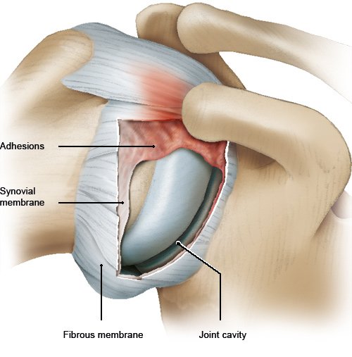 Illustration: Frozen shoulder: Scar-like tissue (adhesions) in the joint capsule – as described in the article