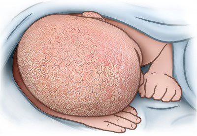 Illustration: Seborrheic dermatitis (cradle cap) on a baby's scalp – as described in the information