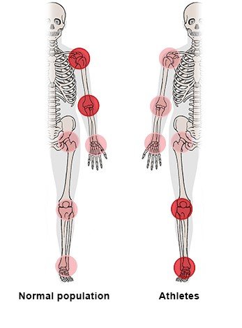 Illustration: Comparison of areas commonly affected by tendon overuse injuries