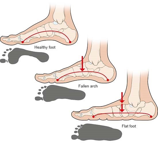 Illustration: Healthy foot, fallen arch and flat foot – as described in the article