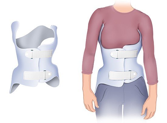 Illustration: A back brace for treating scoliosis