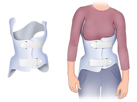 Wait and see, back brace or physical therapy?