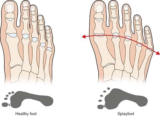Illustration: Healthy foot and splayfoot – as described in the article
