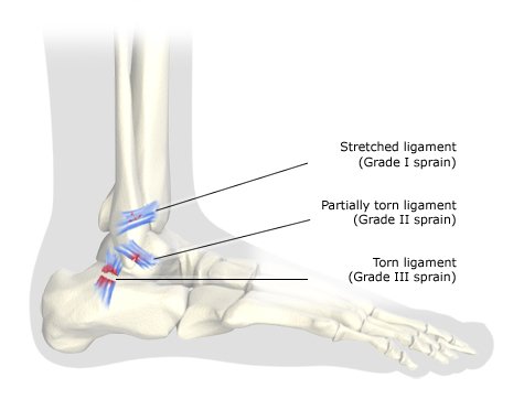 Illustration: Foot bones (outer side) with grade I, II and III sprains – as described in article