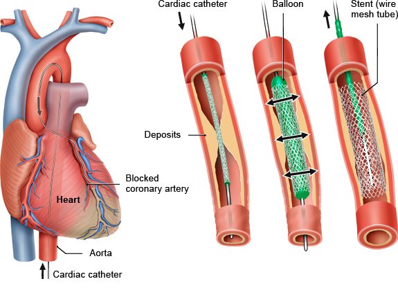 Illustration: Cardiac (heart) catheter with balloon and stent