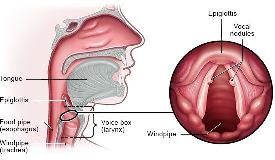 Illustration: Vocal nodules usually occur on both vocal cords, opposite each other – as described in the article