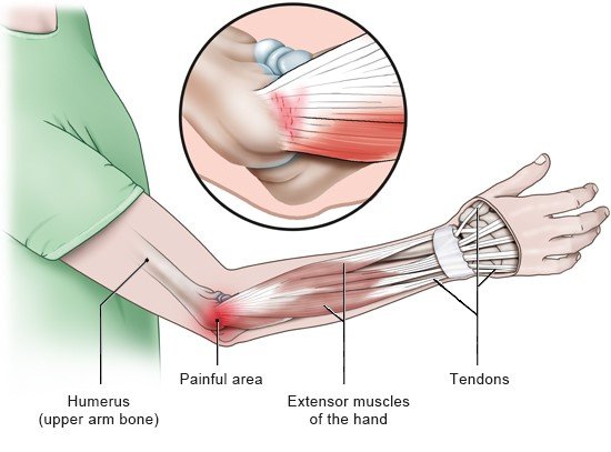 Illustration: Painful area in tennis elbow – as described in the article