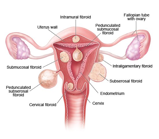 Illustration: Various types of fibroids