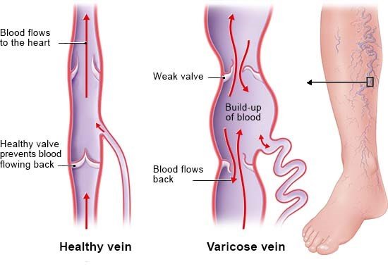 Illustration: Blood flowing backwards in varicose veins in the legs