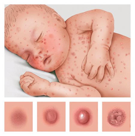 Baby with a typical chickenpox rash. Below: Development of a chickenpox blister