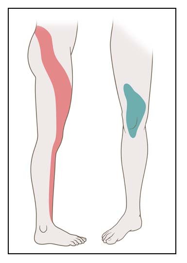 The illustration shows where sciatica symptoms can occur if you have a pinched nerve at the 4th lumbar vertebra.